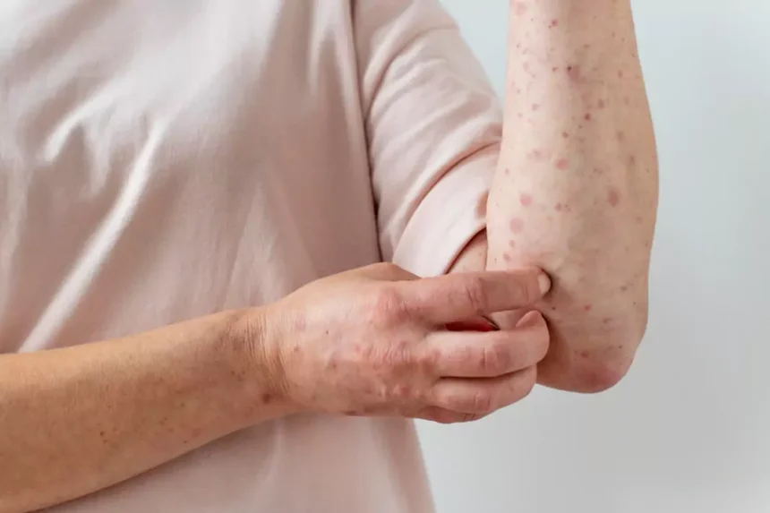measles romania